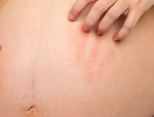 Hamilelikte Deri Testi: Alerji Tanısı İçin Güvenli mi?
