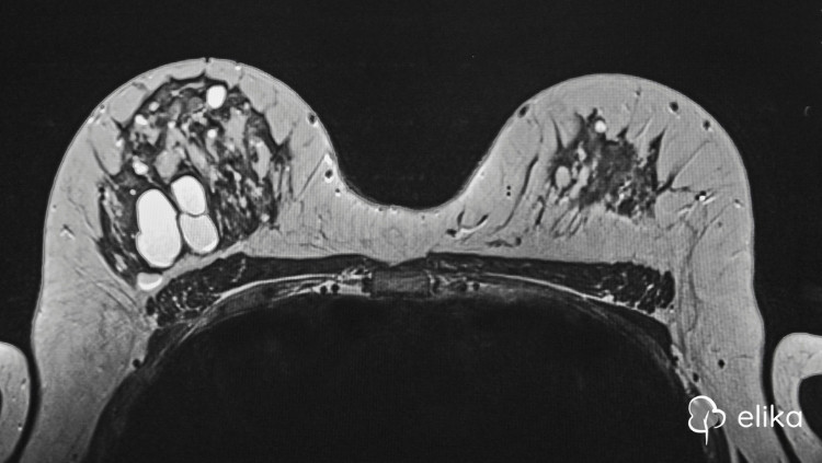 kadinlarda-cikolata-kistleri-endometrioma-tani-ve-tedavi.jpg